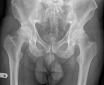 Xray of severe bilateral hip osteoarthritis